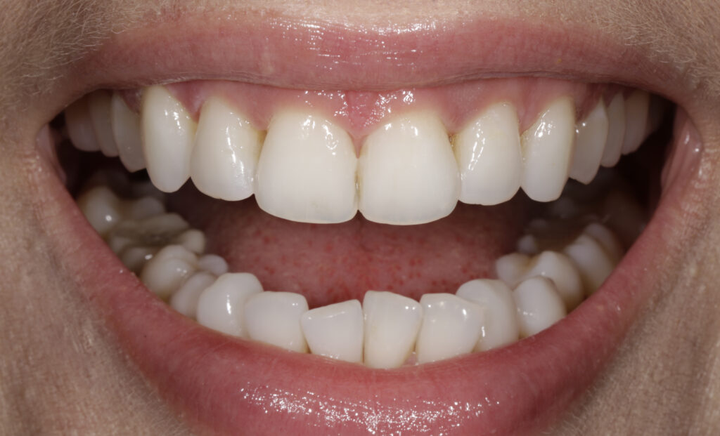 Kuva suoremmista hampaista oikomishoidon jälkeen. Uudella menetelmällä vähemmän hoitokäyntejä. 